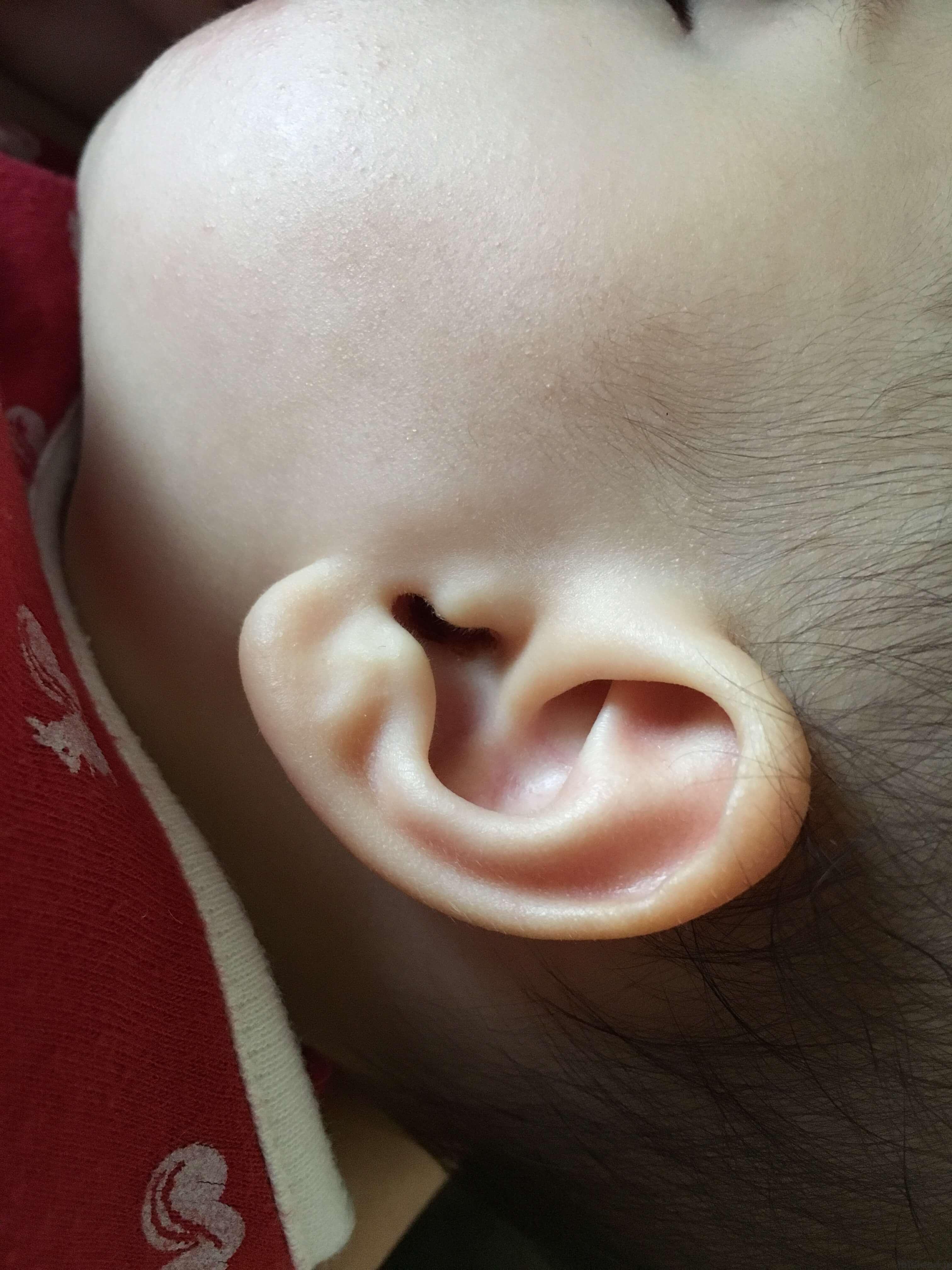 鼓膜切開後の耳垂れ1